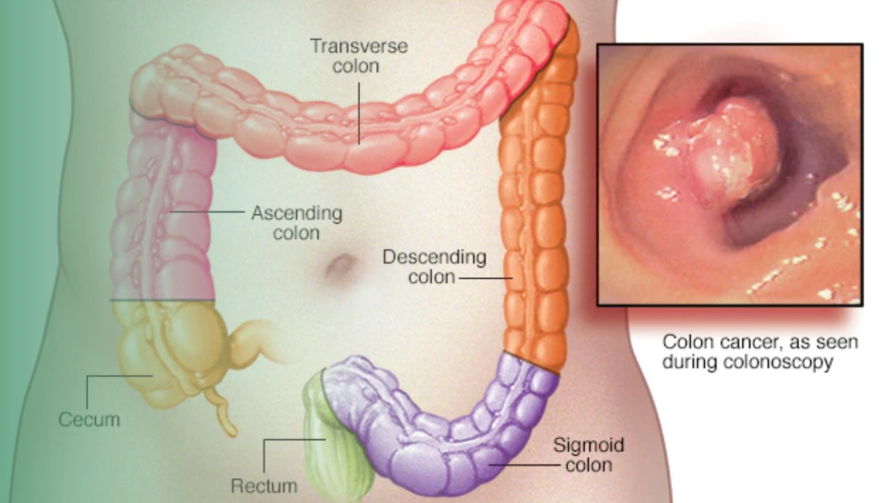 Kanker usus besar